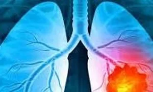 Khám sức khỏe định kỳ, hai phụ nữ bất ngờ nhận chẩn đoán ung thư phổi Khám sức khỏe định kỳ, hai phụ nữ bất ngờ nhận chẩn đoán ung thư phổi